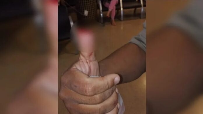 mulher-arranca-parte-do-dedo-polegar-de-policial-com-mordida-durante-abordagem mulher-arranca-parte-do-dedo-polegar-de-policial-com-mordida-durante-abordagem